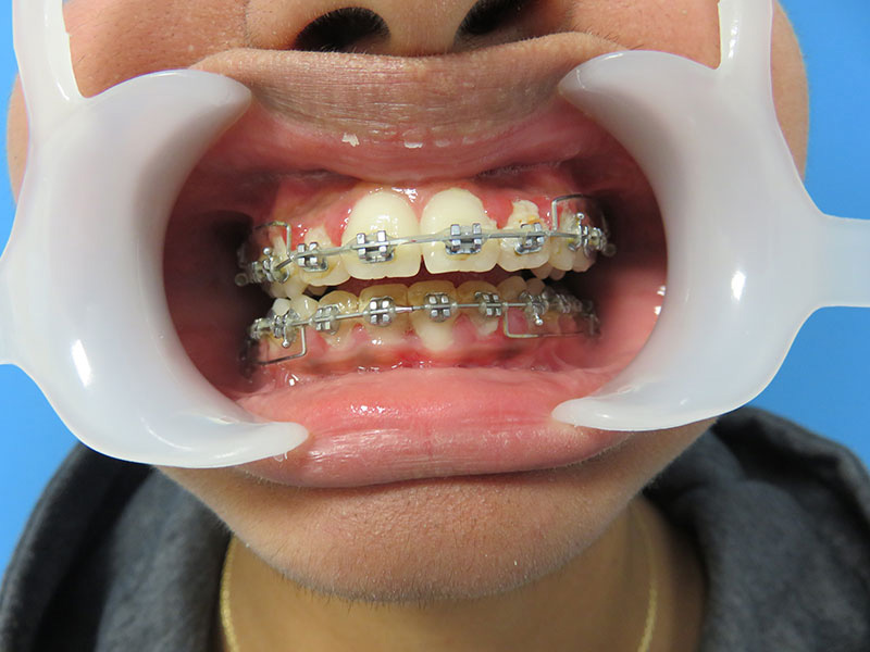 classe 2 liée à une recul de la mandibule et/ou à une avancée du maxillaire superieur : conséquence dentaire articulaire et morphologique