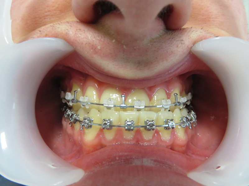 classe 3 liée à une avancee de la mandibule ou/et à un recul du maxillaire superieur : conséquence dentaire articulaire et morphologique